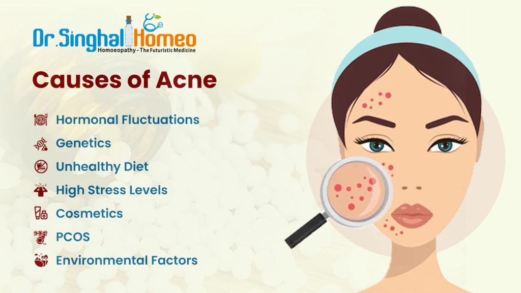 Homeopathic Medicine for Acne and Pimples